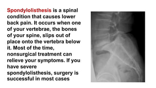 Spondylolisthesis is a spinal
condition that causes lower
back pain. It occurs when one
of your vertebrae, the bones
of your spine, slips out of
place onto the vertebra below
it. Most of the time,
nonsurgical treatment can
relieve your symptoms. If you
have severe
spondylolisthesis, surgery is
successful in most cases
 