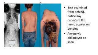 • Best examined
from behind,
notice any
curvature Rib
hump appear on
bending
• Any pelvic
obliquityto be
seen
 