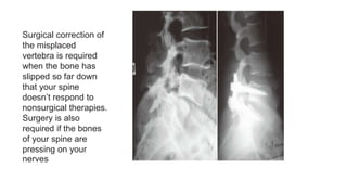 Surgical correction of
the misplaced
vertebra is required
when the bone has
slipped so far down
that your spine
doesn’t respond to
nonsurgical therapies.
Surgery is also
required if the bones
of your spine are
pressing on your
nerves
 