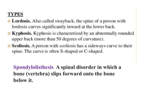 Spondylolisthesis A spinal disorder in which a
bone (vertebra) slips forward onto the bone
below it.
 