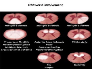 Transverse involvement
 