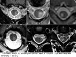 On transverse images MS lesions typically have a round or triangular shape and are located
posteriorly or laterally
 