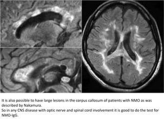 It is also possible to have large lesions in the corpus callosum of patients with NMO as was
described by Nakamura.
So in any CNS disease with optic nerve and spinal cord involvement it is good to do the test for
NMO-IgG.
 