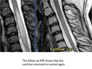 The follow up MR shows that the
cord has returned to normal again
 