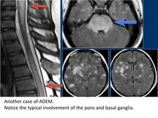 Another case of ADEM.
Notice the typical involvement of the pons and basal ganglia.
 