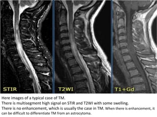 Here images of a typical case of TM.
There is multisegment high signal on STIR and T2WI with some swelling.
There is no enhancement, which is usually the case in TM. When there is enhancement, it
can be difficult to differentiate TM from an astrocytoma.
 