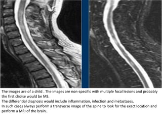 The images are of a child . The images are non-specific with multiple focal lesions and probably
the first choise would be MS.
The differential diagnosis would include inflammation, infection and metastases.
In such cases always perform a transverse image of the spine to look for the exact location and
perform a MRI of the brain.
 