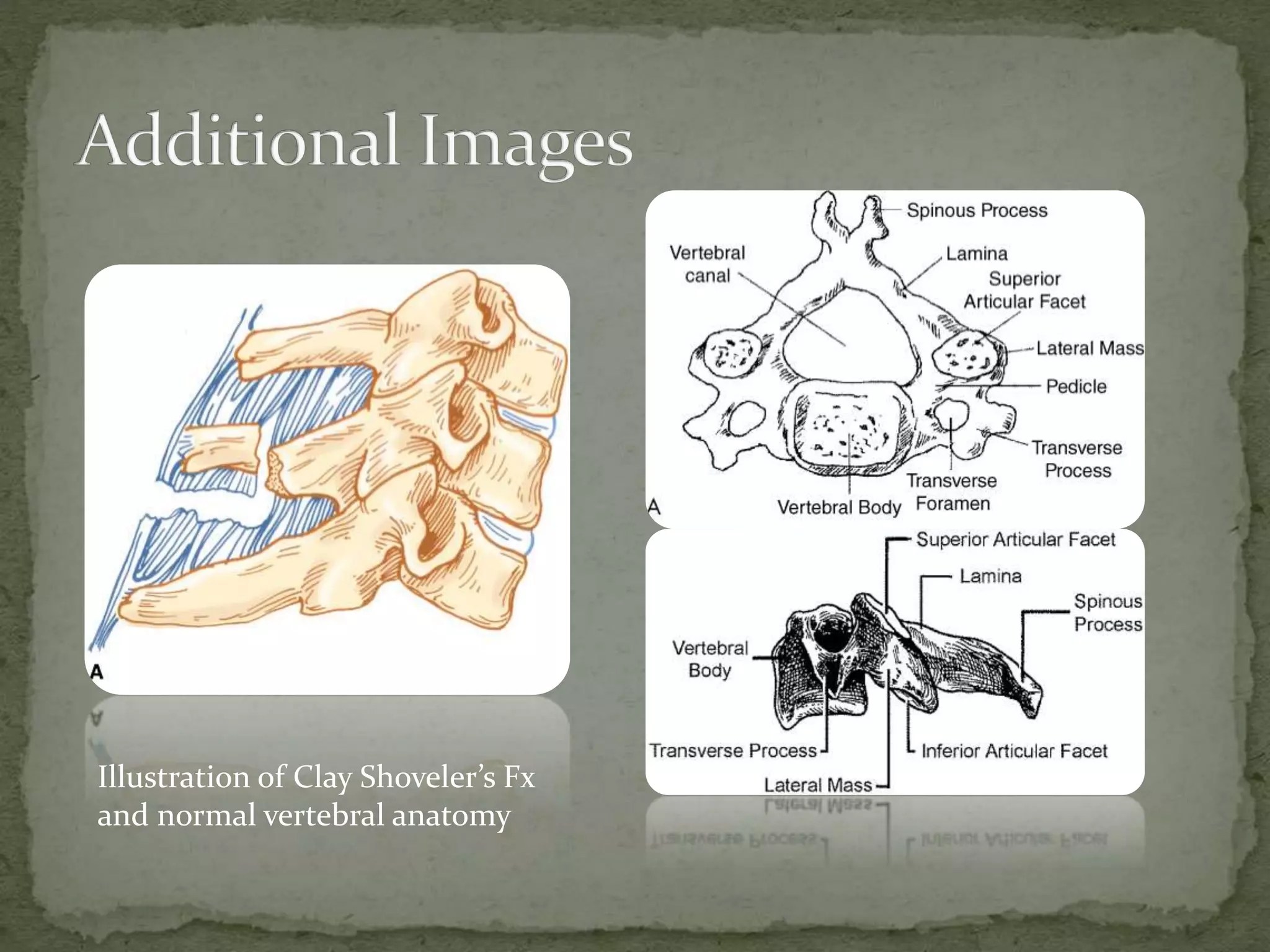 Illustration of Clay Shoveler’s Fx
and normal vertebral anatomy