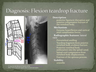 •

Description
•

•

Mechanism
•

•

•
•

•

Prevertebral swelling
Teardrop fragment from anterior
vertebral body avulsion fracture.
Posterior vertebral body
subluxation into the spinal canal.
Spinal cord compression from
vertebral body displacement.
Fracture of the spinous process.

Stability
•

© 2000 by the Rector & Visitors of the University of Virginia
http://www.med-ed.virginia.edu/courses/rad/cspine

Extreme hyperflexion and vertical
axial compression forces.

Radiographic features: lateral
view
•
•

•

posterior ligament disruption and
anterior compression fracture of
the vertebral body.

unstable

 