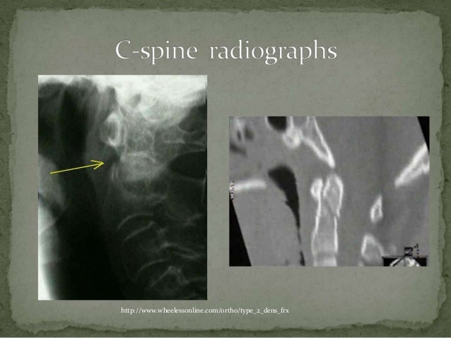 odontoid fracture non healing icd 10 odontoid fracture non healing icd 10