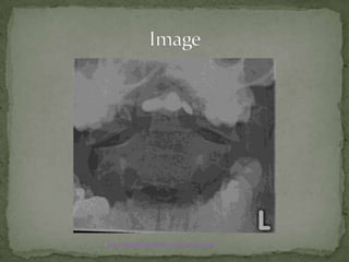 :http://imageinterpretation.co.uk/cervical.html

 