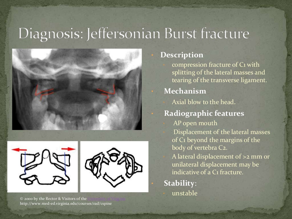 Jefferson Burst Fracture