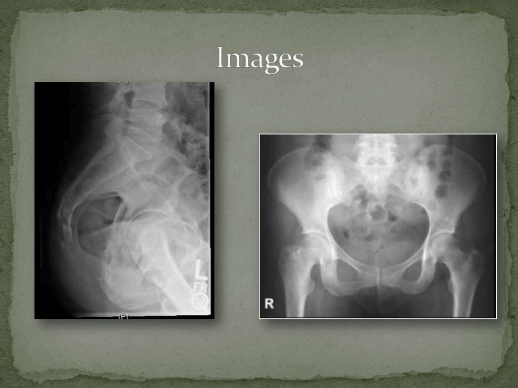 Coccyx Fracture
