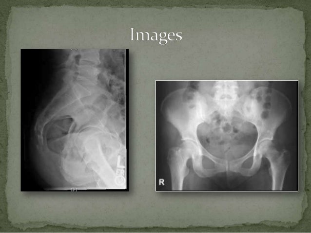 Coccyx Fracture