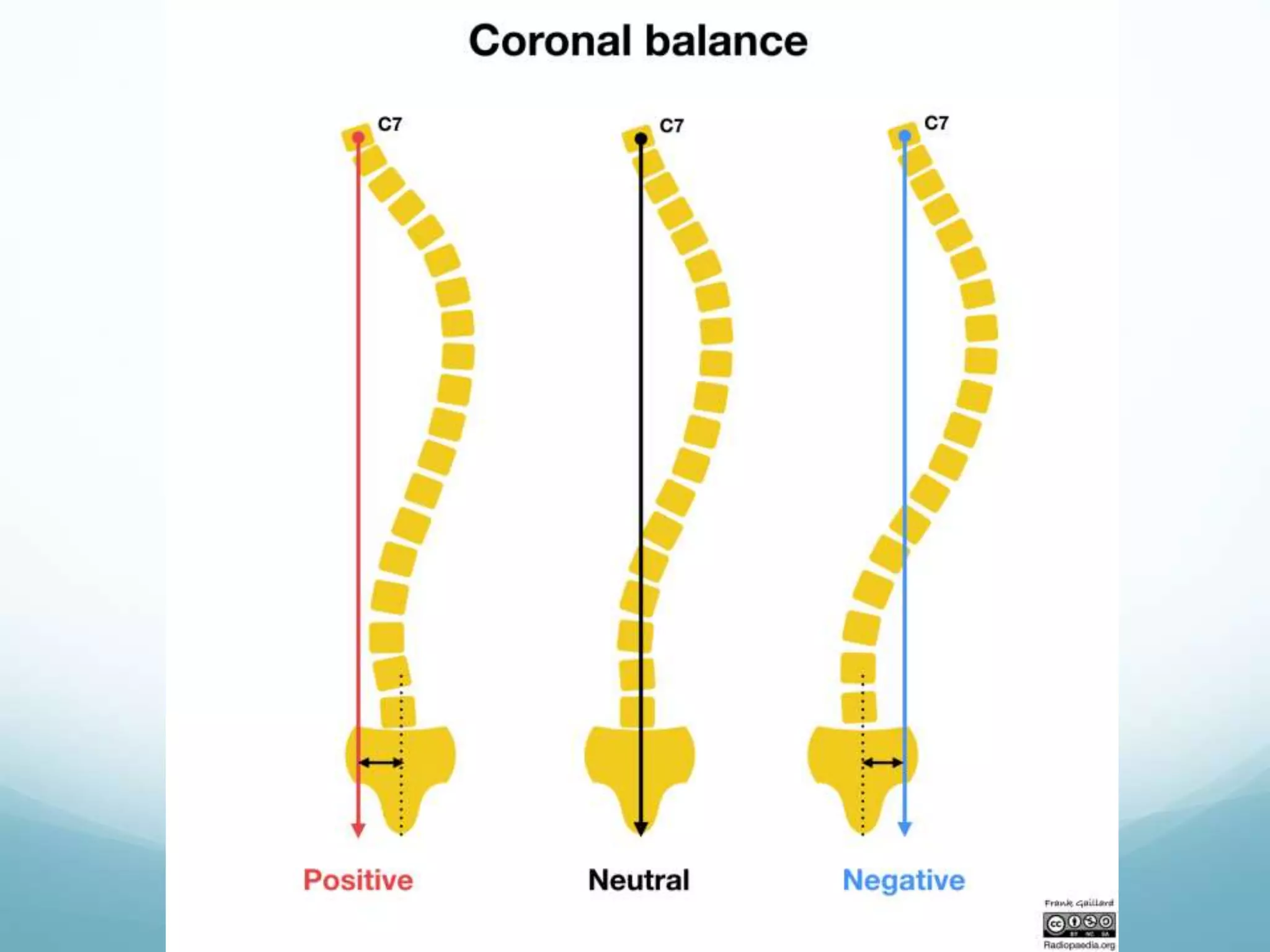 Evaluation of Spinal alignment | PPT