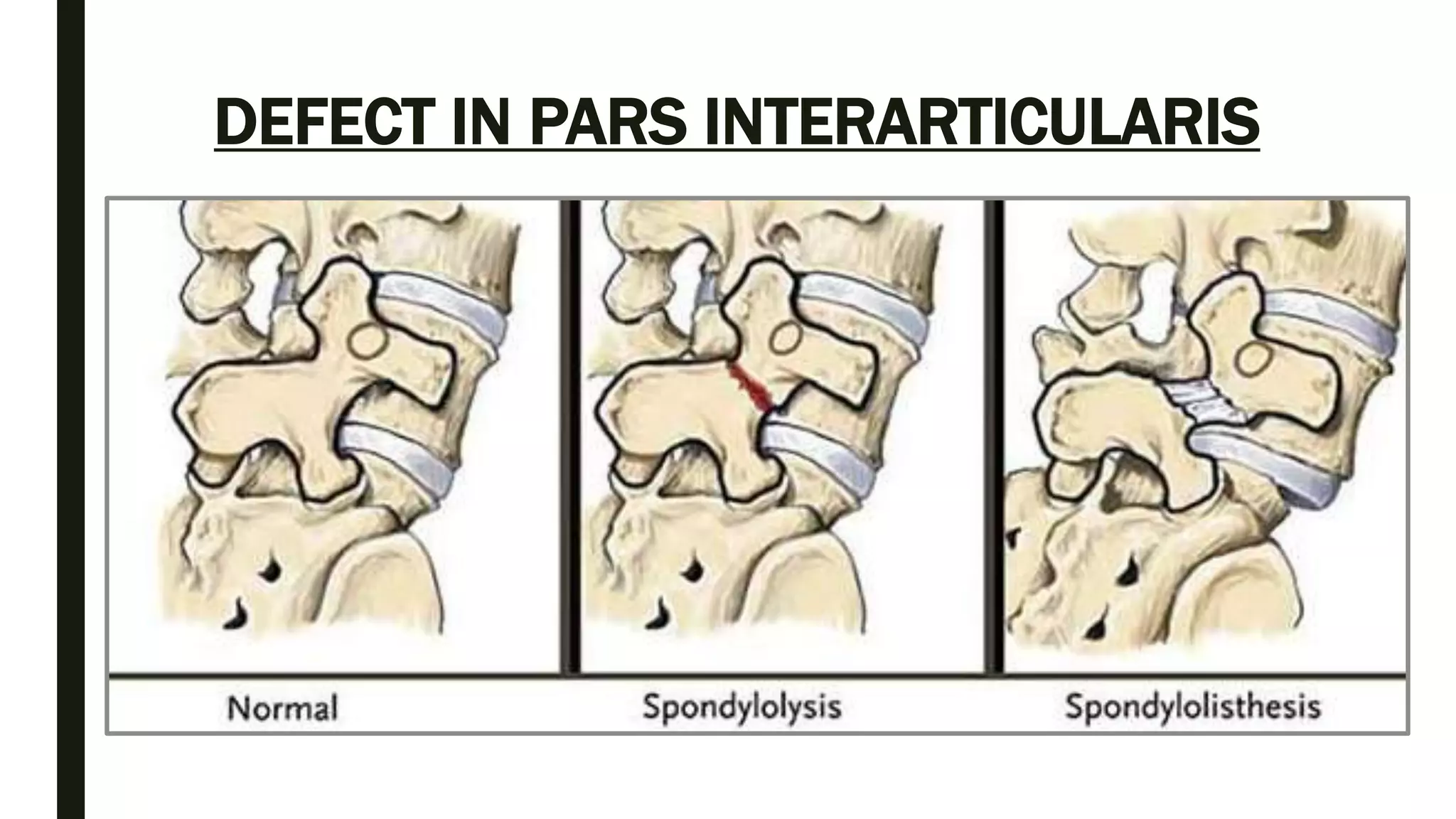 Pars Defects Radiopadia Spine anatomy and xray of spine ppt by Dr Pratik | PPTX