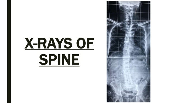 Spine anatomy and xray of spine ppt by Dr Pratik