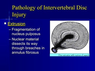 Pathology of Intervertebral DiscPathology of Intervertebral Disc
InjuryInjury
 ExtrusionExtrusion
– Fragmentation ofFragmentation of
nucleus pulposusnucleus pulposus
– Nuclear materialNuclear material
dissects its waydissects its way
through breaches inthrough breaches in
annulus fibrosusannulus fibrosus
 