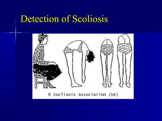 Detection of ScoliosisDetection of Scoliosis
 