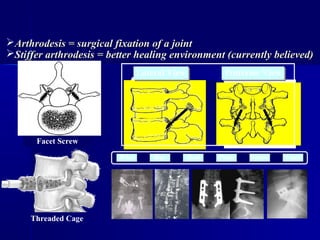 Lateral ViewLateral View Posterior ViewPosterior View
RodWire Bar CagePlate Screw
Pedicle Screw
Threaded Cage
Facet Screw
Arthrodesis = surgical fixation of a jointArthrodesis = surgical fixation of a joint
Stiffer arthrodesis = better healing environment (currently believed)Stiffer arthrodesis = better healing environment (currently believed)
 