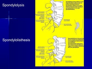 Spondylolysis
Spondylolisthesis
 