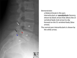 Spine Case presentation.pptxSpine Case presentation.pptx
