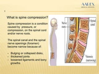 .
What is spine compression?
Spine compression is a condition
caused by pressure, or
compression, on the spinal cord
and/or nerve roots.
The spinal canal and the spinal
nerve openings (foramen)
become narrow because of:
- Bulging or collapsed disks,
- thickened joints
- loosened ligaments and bony
growths
 