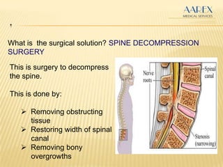 .
What is the surgical solution? SPINE DECOMPRESSION
SURGERY
This is surgery to decompress
the spine.
This is done by:
 Removing obstructing
tissue
 Restoring width of spinal
canal
 Removing bony
overgrowths
 