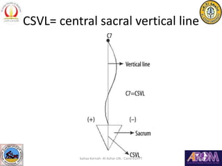 CSVL= central sacral vertical line
bahaa Kornah- Al-Azhar UN.- Cairo-EGYPT
 