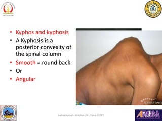 • Kyphos and kyphosis
• A Kyphosis is a
posterior convexity of
the spinal column
• Smooth = round back
• Or
• Angular
baha...