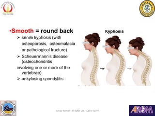 •Smooth = round back
 senile kyphosis (with
osteoporosis, osteomalacia
or pathological fracture)
 Scheuermann’s disease
...