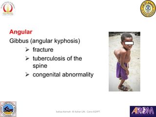 Angular
Gibbus (angular kyphosis)
 fracture
 tuberculosis of the
spine
 congenital abnormality
bahaa Kornah- Al-Azhar U...