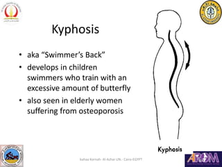 Kyphosis
• aka “Swimmer’s Back”
• develops in children
swimmers who train with an
excessive amount of butterfly
• also see...