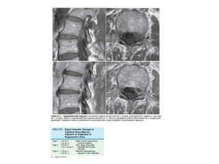 Spine  degenerative  disease     