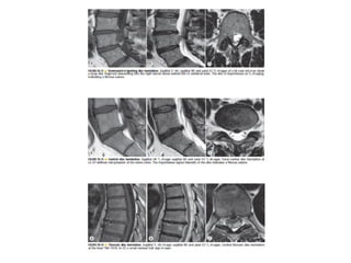Spine  degenerative  disease     