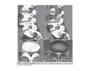 Spine  degenerative  disease     