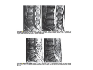 Spine  degenerative  disease     