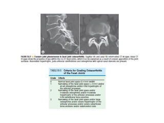 Spine  degenerative  disease     
