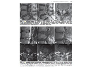 Spine  degenerative  disease     