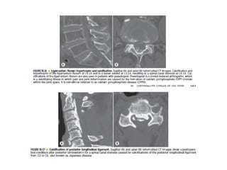 Spine  degenerative  disease     