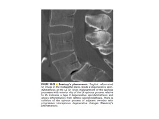 Spine  degenerative  disease     