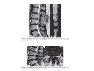 Spine  degenerative  disease     