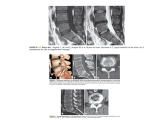 Spine  degenerative  disease     