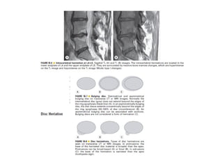 Spine  degenerative  disease     