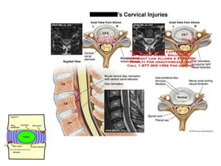Spine  degenerative  disease     