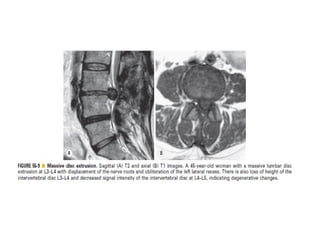 Spine  degenerative  disease     