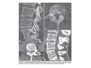 Spine  degenerative  disease     