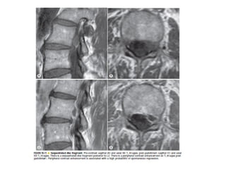 Spine  degenerative  disease     