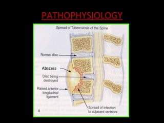 Spine infection Slide 19