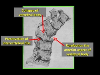 Preservation of intervertebral disc Collapse of vertebral body Rarefaction the anterior aspect of vertebral body 